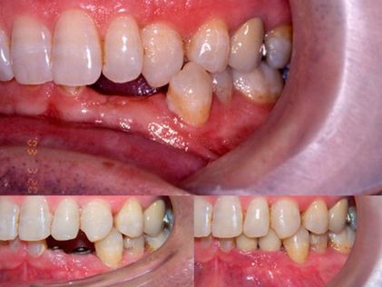 Clínica Dental Doctor Catalán correcciones dentales 2