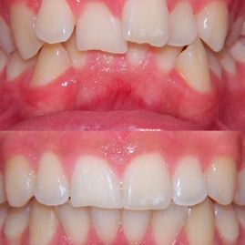 Clínica Dental Doctor Catalán correcciones dentales 4