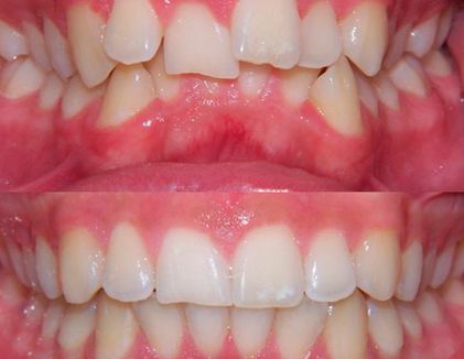 Clínica Dental Doctor Catalán correcciones dentales 4