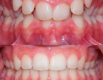 Clínica Dental Doctor Catalán correcciones dentales 5