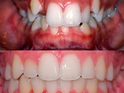 Clínica Dental Doctor Catalán correcciones dentales 1