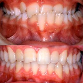 Clínica Dental Doctor Catalán correcciones dentales 9