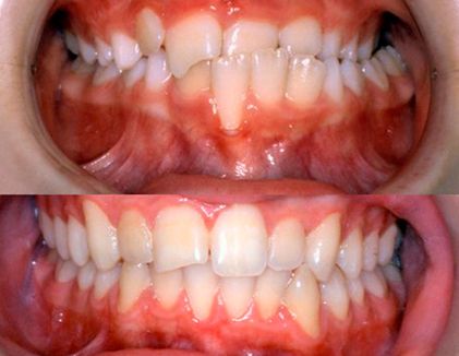Clínica Dental Doctor Catalán correcciones dentales 9