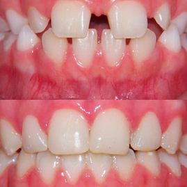 Clínica Dental Doctor Catalán correcciones dentales 8