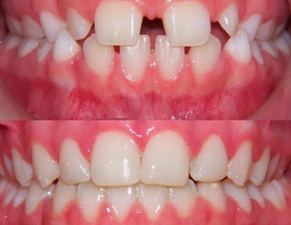 Clínica Dental Doctor Catalán correcciones dentales 8