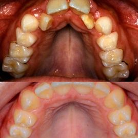 Clínica Dental Doctor Catalán correcciones dentales 6