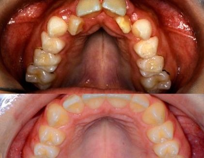 Clínica Dental Doctor Catalán correcciones dentales 6
