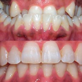 Clínica Dental Doctor Catalán correcciones dentales 7