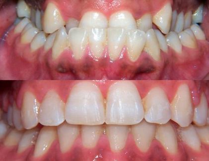 Clínica Dental Doctor Catalán correcciones dentales 7